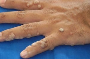  human papillomavirus (HPV) on hands
